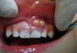 Cách điều trị viêm chân răng có mủ NHANH NHẤT