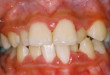 Viêm chân răng là một trong những bệnh lý răng miệng khiến bạn bị mất răng