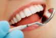 Bọc răng sứ sử dụng được bao lâu? Xem chi tiết tại đây