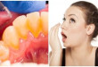 Cao răng có gây hôi miệng không? [Kiến thức nha khoa]