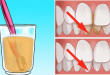Lấy cao răng bằng phương pháp tự nhiên nhanh và hiệu quả cao