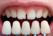 Quy trình bọc răng sứ như thế nào là đảm bảo đều đẹp, ăn nhai bền vững?