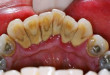 Những sai lầm khi chăm sóc răng miệng khiến cao răng dày lên