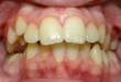 Chụp răng sứ làm thay đổi nụ cười của hàng triệu người như thế nào?