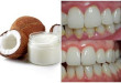 3 cách lấy cao răng bằng dầu dừa hiệu quả ngay lập tức