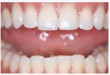 Phục hình răng sứ cho trường hợp răng hư hỏng, sứt mẻ, nhiễm màu