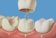 Làm cầu răng sứ thẩm mỹ >>>> Giải pháp cho hàm răng hoàn hảo