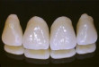Sự thật về bọc răng sứ alumina có tốt và bền không? >>> Tư vấn tư chuyên gia