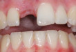 Thực hư việc mất răng làm tăng khả năng gây ung thư