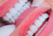 Điều trị răng nhiễm màu do nhân tố bên trong cơ thể