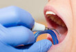 Lấy cao răng về bị chảy máu – Những mối lo cần phải dè chừng