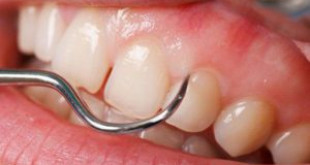 Lấy cao răng nha khoa có quy trình thực hiện như thế nào?