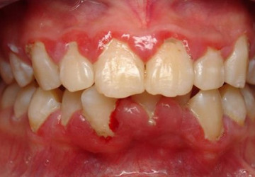 Bị tụt nướu răng – Điều trị NHANH CHÓNG và TRIỆT ĐỂ nhất