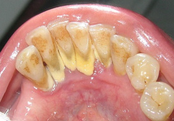 Cao răng quá nhiều – Thật nguy hiểm nếu không tìm cách giải quyết ngay