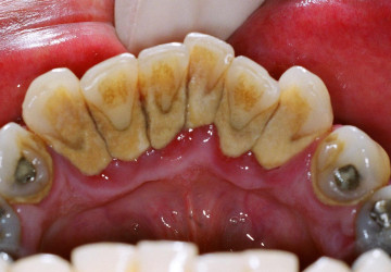 Lấy cao răng có đau không? – Lắng nghe tâm sự cùng chuyên gia