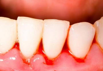 Tác hại của vôi răng đến sức khỏe không hề đơn giản >> Xem ngay