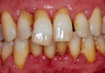 Bạn có đang nhận ra mình bị viêm nha chu – Căn bệnh răng miệng nguy hiểm?